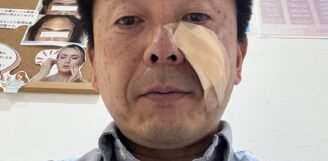 ホクロ切除手術しました！